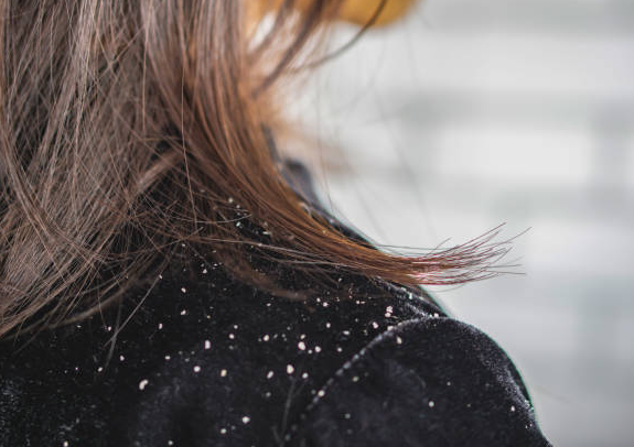 Dandruff