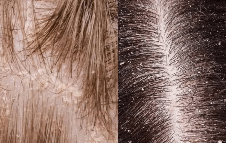 Dandruff vs. Dry Scalp: Everything You Need to Know